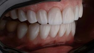 Kieferostitis: Verborgenes Leiden im Knochengerüst